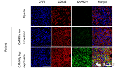 图:正常组织和mm病人髓外浸润组织代表性的免疫荧光图实验证明,敲除