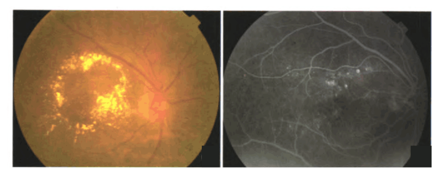 临床有意义的糖尿病性黄斑水肿(左:彩色眼底图像;右:眼底荧光造影)