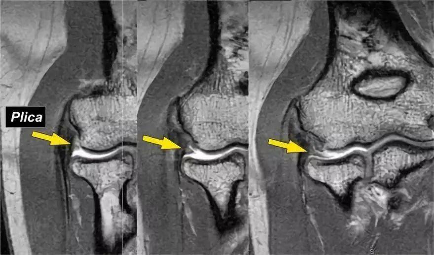 肘關節mr解剖及疾病詳解