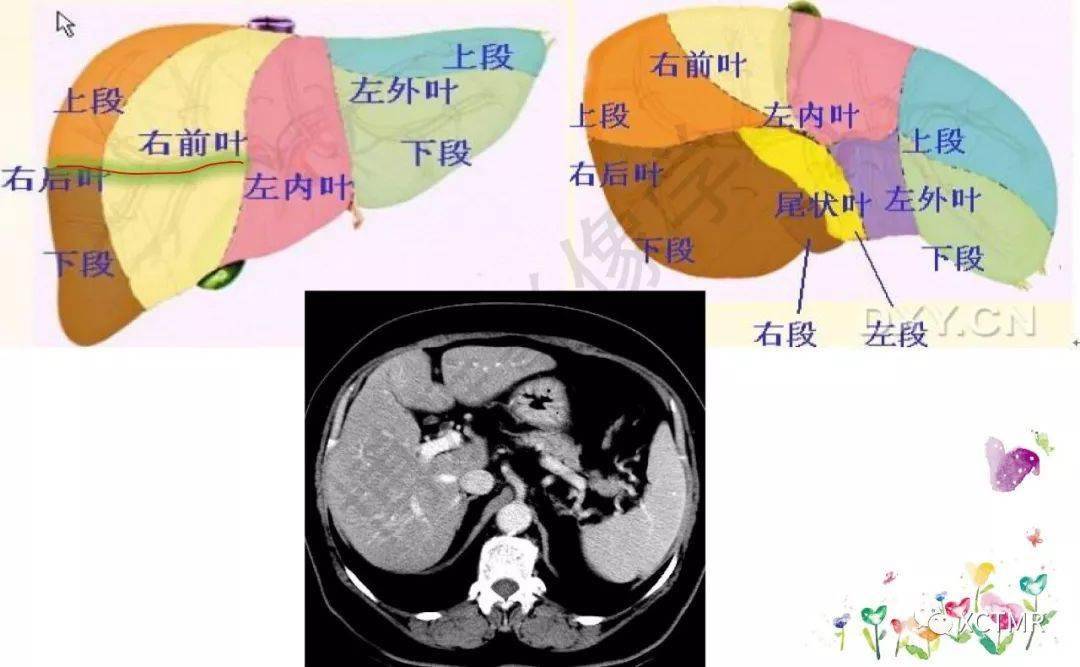 收藏丨肝脏分叶分段的影像解剖