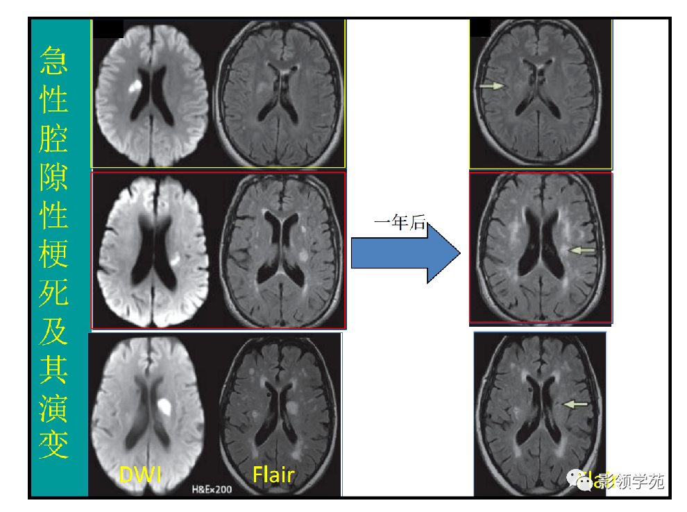 脑小血管病的影像学诊断