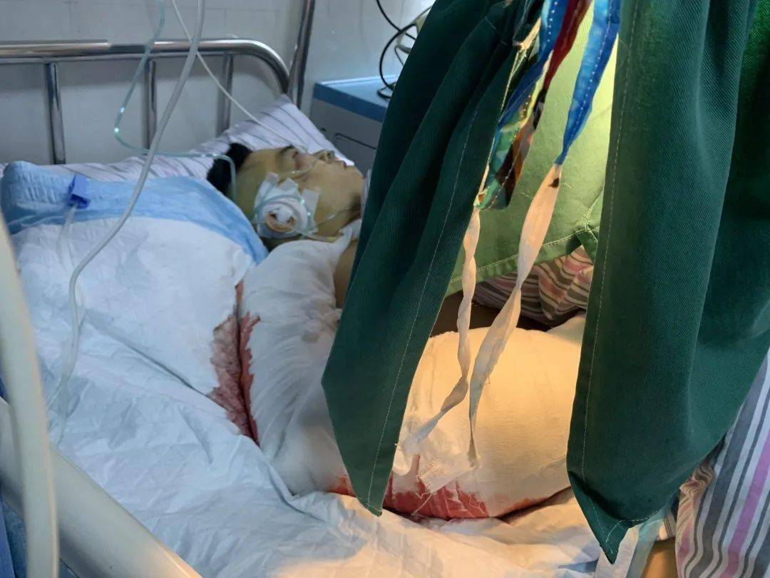 紧急救援工人手臂被机器绞断8小时手术成功再植