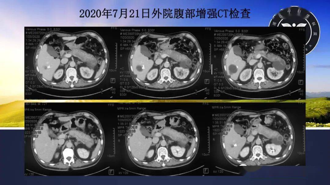 胰腺丨igg4相關性自身免疫性胰腺炎