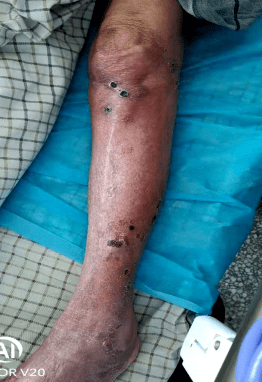 这时患者细菌培养结果回示:诺卡氏菌,遂联系内五科石文芳主任再次会诊