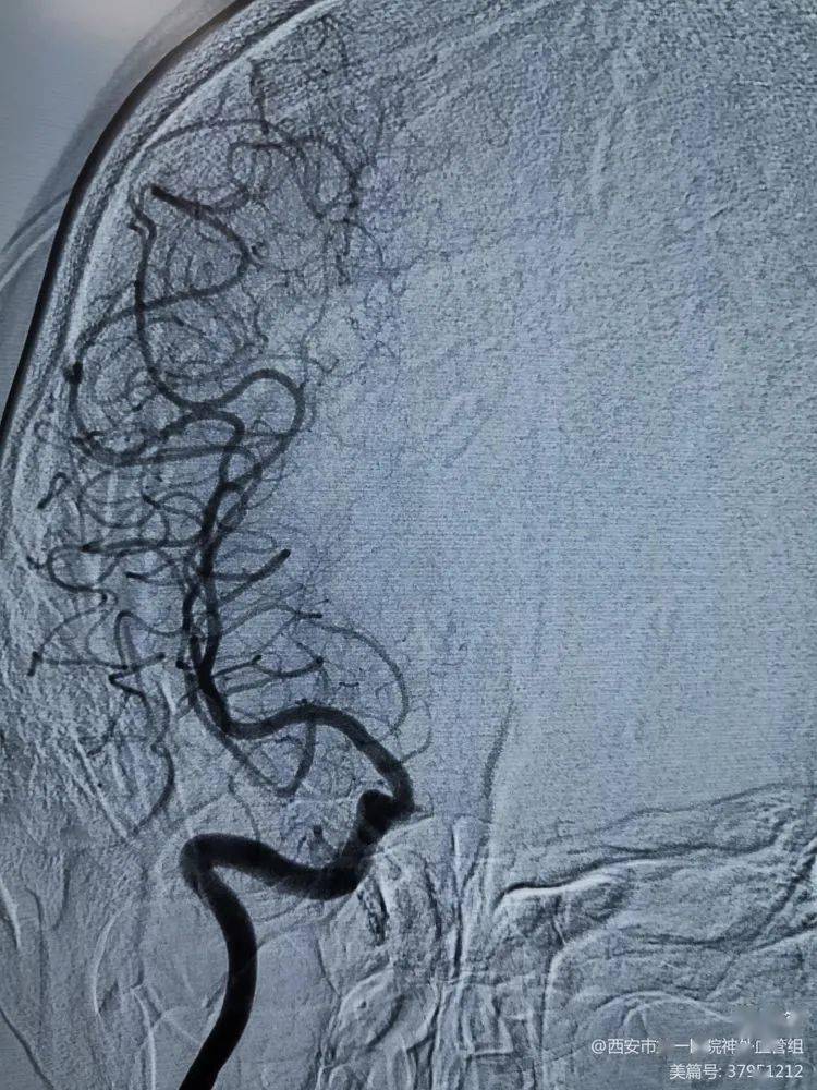 【世界卒中日5】椎基底动脉慢闭开通----病例分享