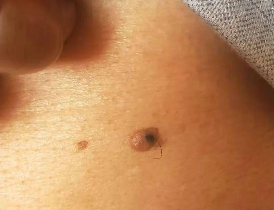 老人的腹部有痣