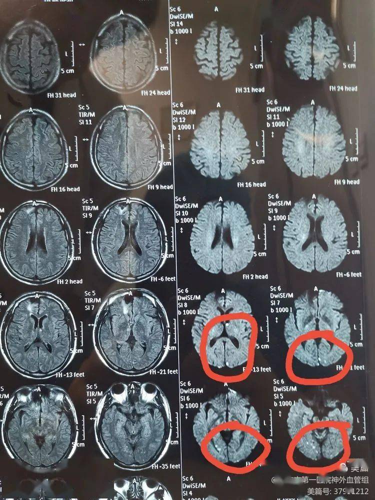 核磁提示多发散在梗死灶(红8715里白点是梗死灶)查体:清醒,粗测