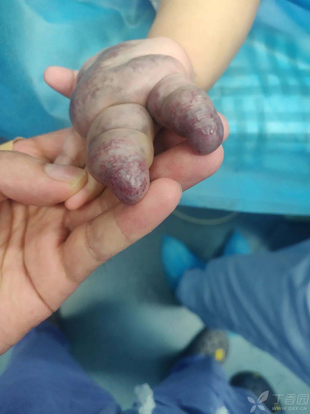 特殊病例婴儿先天手指粗大畸形为何
