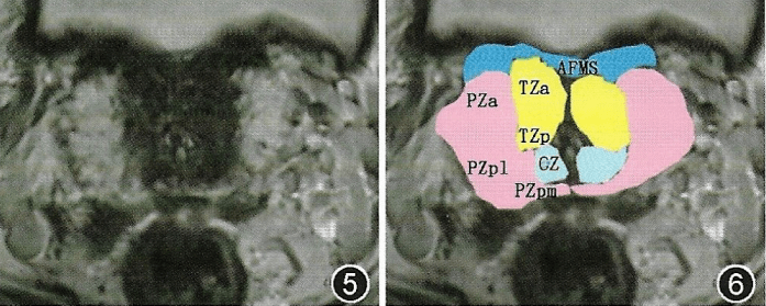 前列腺丨mri解剖分區