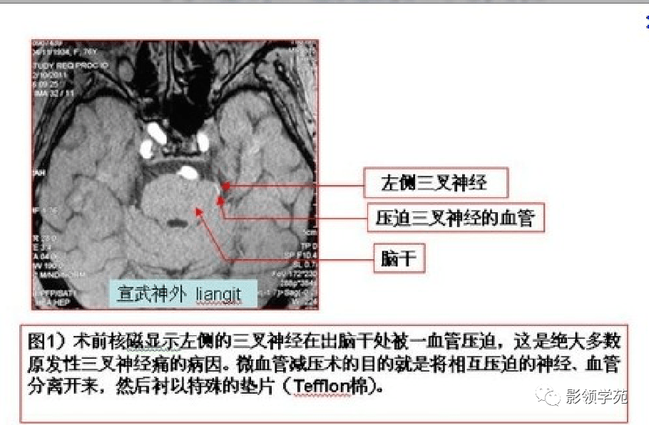 三叉神经影像解剖位置图片