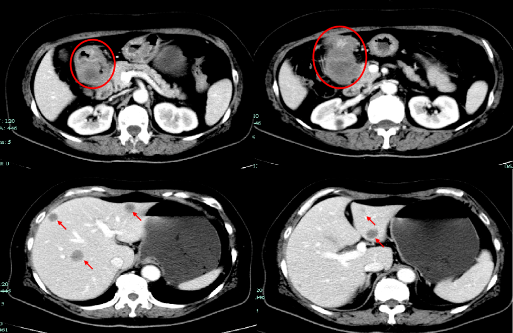 胃癌ct影像图片