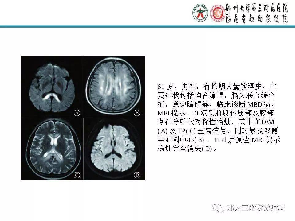 可逆性胼胝体压部病变综合征的影像分析