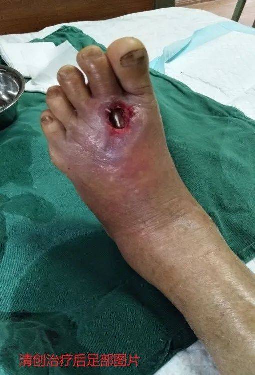 患糖尿病12年,就发生了糖尿病足,这些防治方法早知道就好了