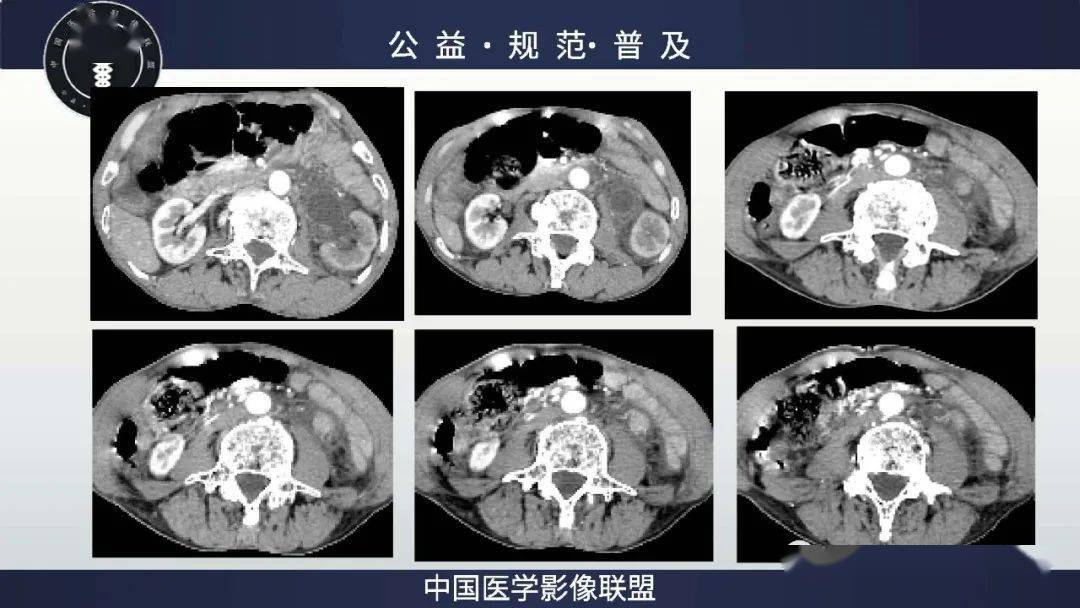 输尿管丨左侧输尿管乳头状癌