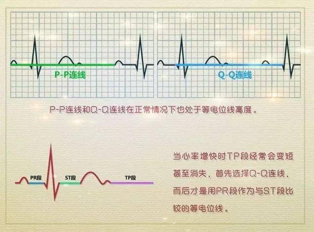 简单4个步骤,读懂st-t段改变特点!_心电图