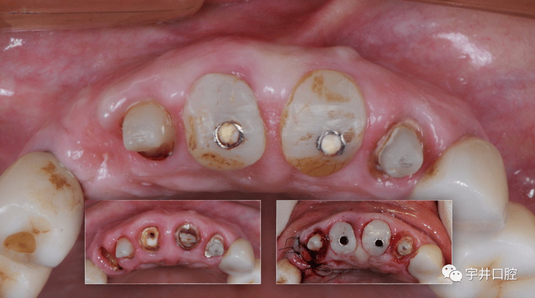 【病例分享】前牙区美学种植