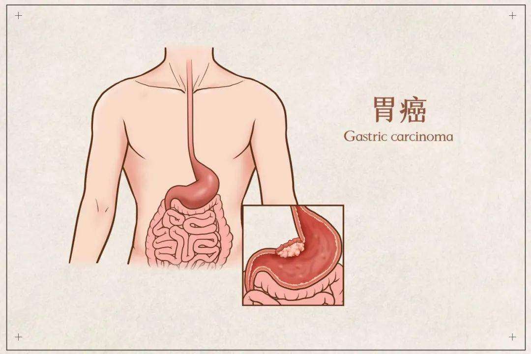 惠仁堂61胃肠关爱日老胃病突然不痛了警惕隐藏的胃肠疾病