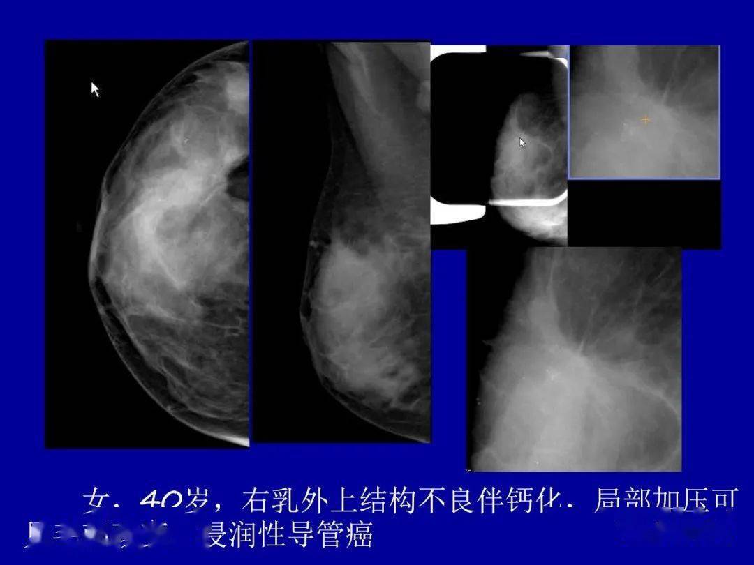 乳腺癌的影像診斷