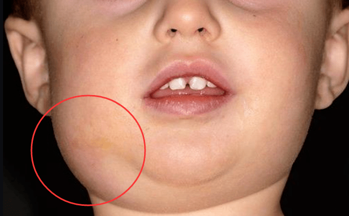 腮腺炎真人图片小孩图片
