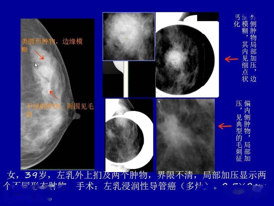 標本切片x線片:乳頭消失,乳頭根本向後凹陷,乳暈增厚,乳暈下脂肪層內