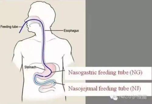 鼻肠管置入位置图片图片