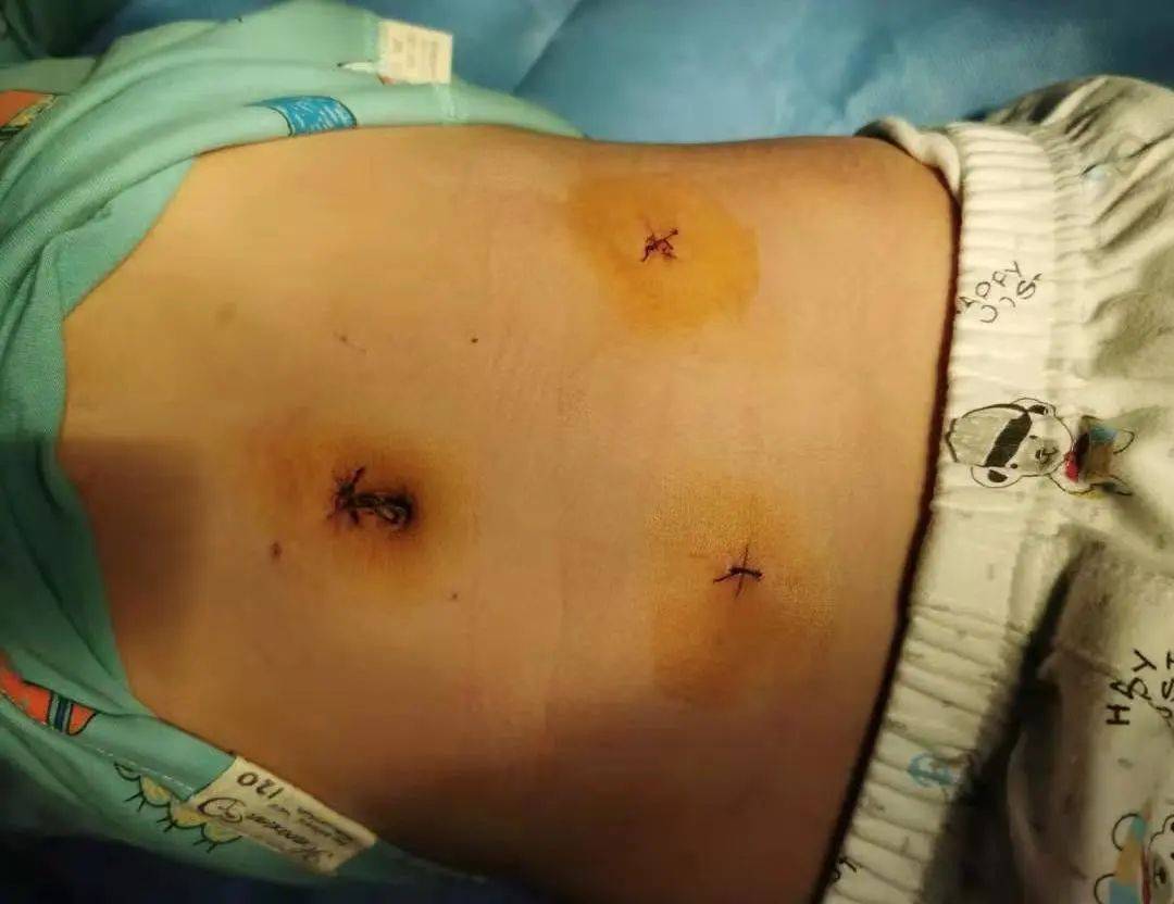 阑尾炎手术微创后图片图片