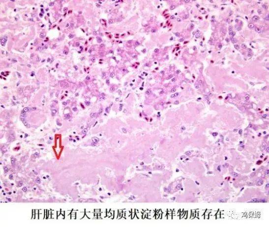 养鸡技术鸡肝脏肿大出血再认识淀粉样变