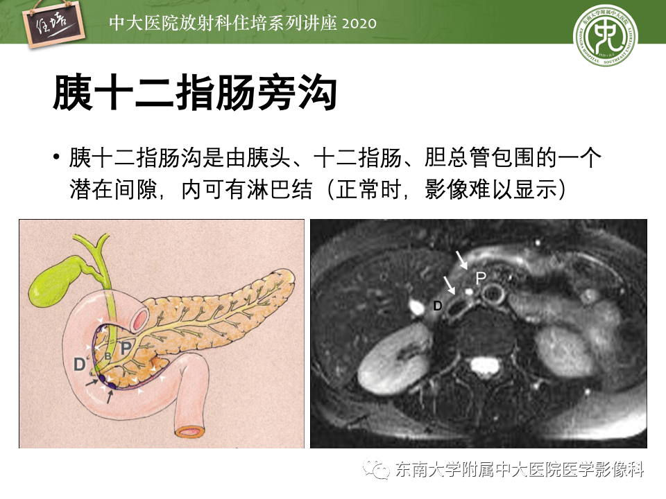 中大放射住培系列講座十二指腸旁胰腺炎的影像評估及鑑別診斷