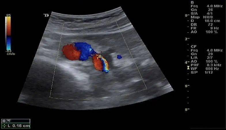 超声科普浅谈肾动脉狭窄