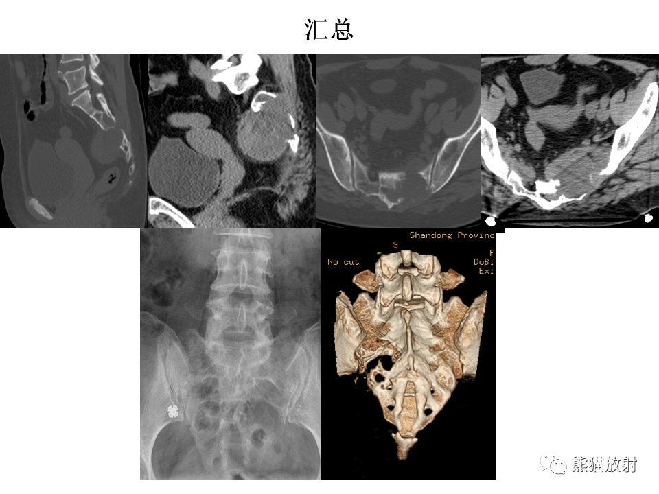 省立影像读片 骶骨病变 20 12