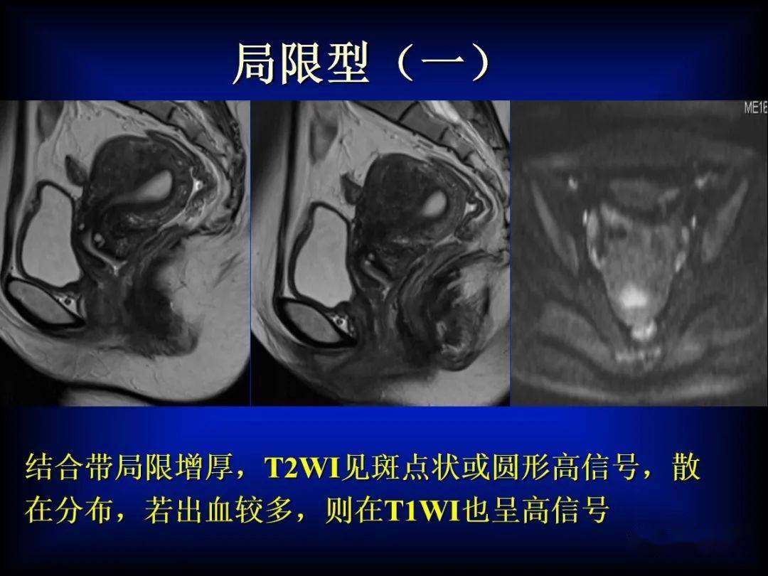 子宫腺肌症的MRI表现_内膜