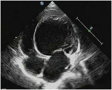 心内膜胶原弹力纤维增生症 (endocardial fibroelastosis,efe) 是指心