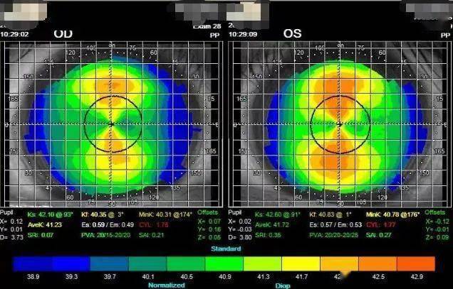 角膜地形图显示角膜形态和曲率数值
