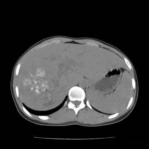 肝包虫(泡状棘球蚴)_手机搜狐网