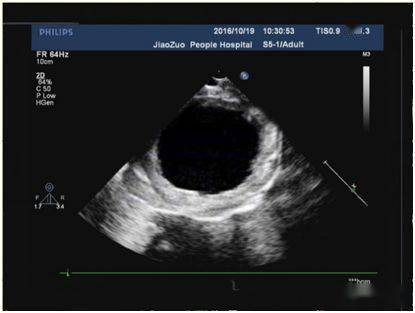 心内膜胶原弹力纤维增生症 (endocardial fibroelastosis,efe) 是指心