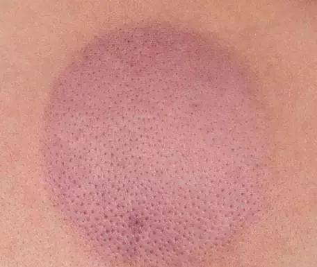 拔火罐后的颜色代表什么?