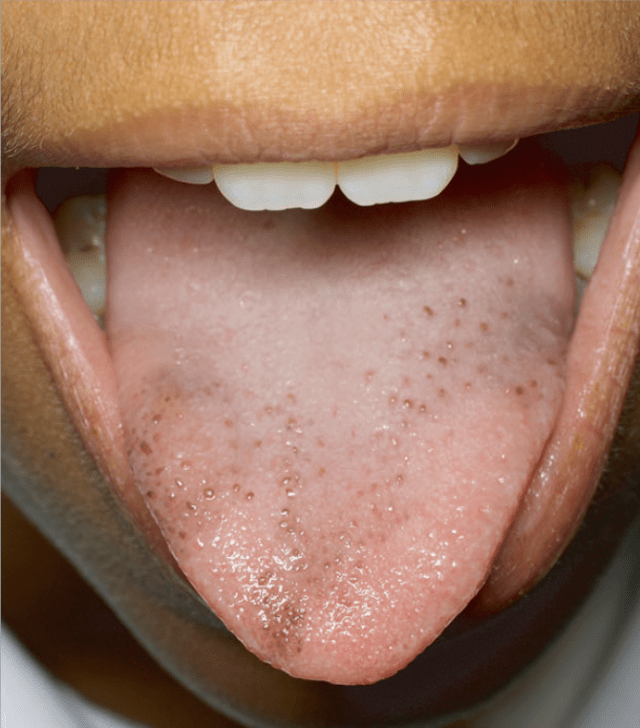 女性舌头上有黑点图片图片
