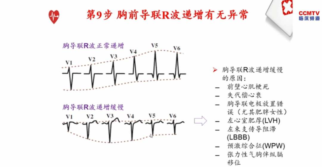 如avr导联st段抬高,6 2现象,v6导联st段偏移幅度大于v1导联