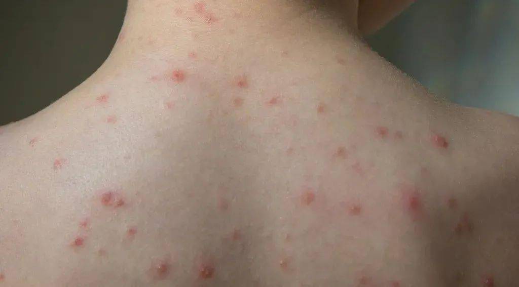 具有高度传染性 好发于儿童和青少年 专家提醒:水痘高发期 江苏扬州