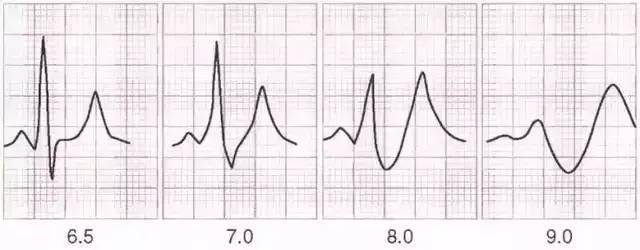 高血钾心电图特征图片