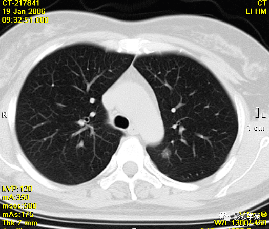 肺泡癌影像诊断与鉴别诊断