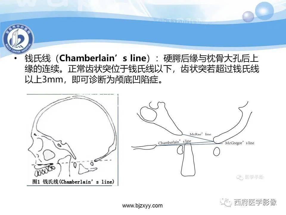 颅底凹陷症的影像诊断与鉴别诊断