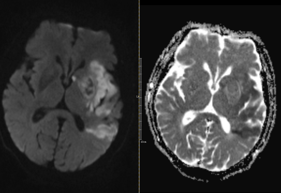 67超急性期大面積腦梗死ct平掃表現