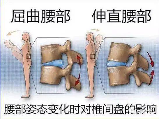 帶您瞭解腰椎間盤突出與腰椎間盤突出症