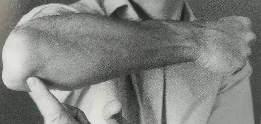 十五,鹰嘴的外侧面鹰嘴的外侧面如图中检查者的示指所示,是肘关节桡侧