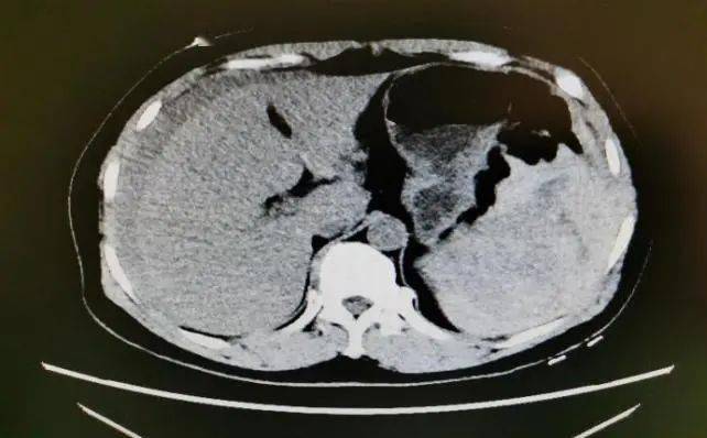 张阿姨腹部ct显示:脾脏破裂,腹腔积血.