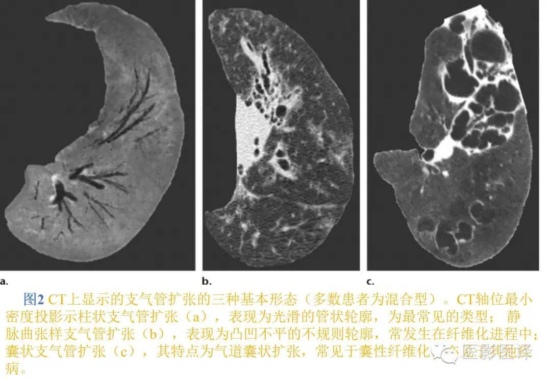 圖文詳析支氣管擴張的機制影像特徵和病因