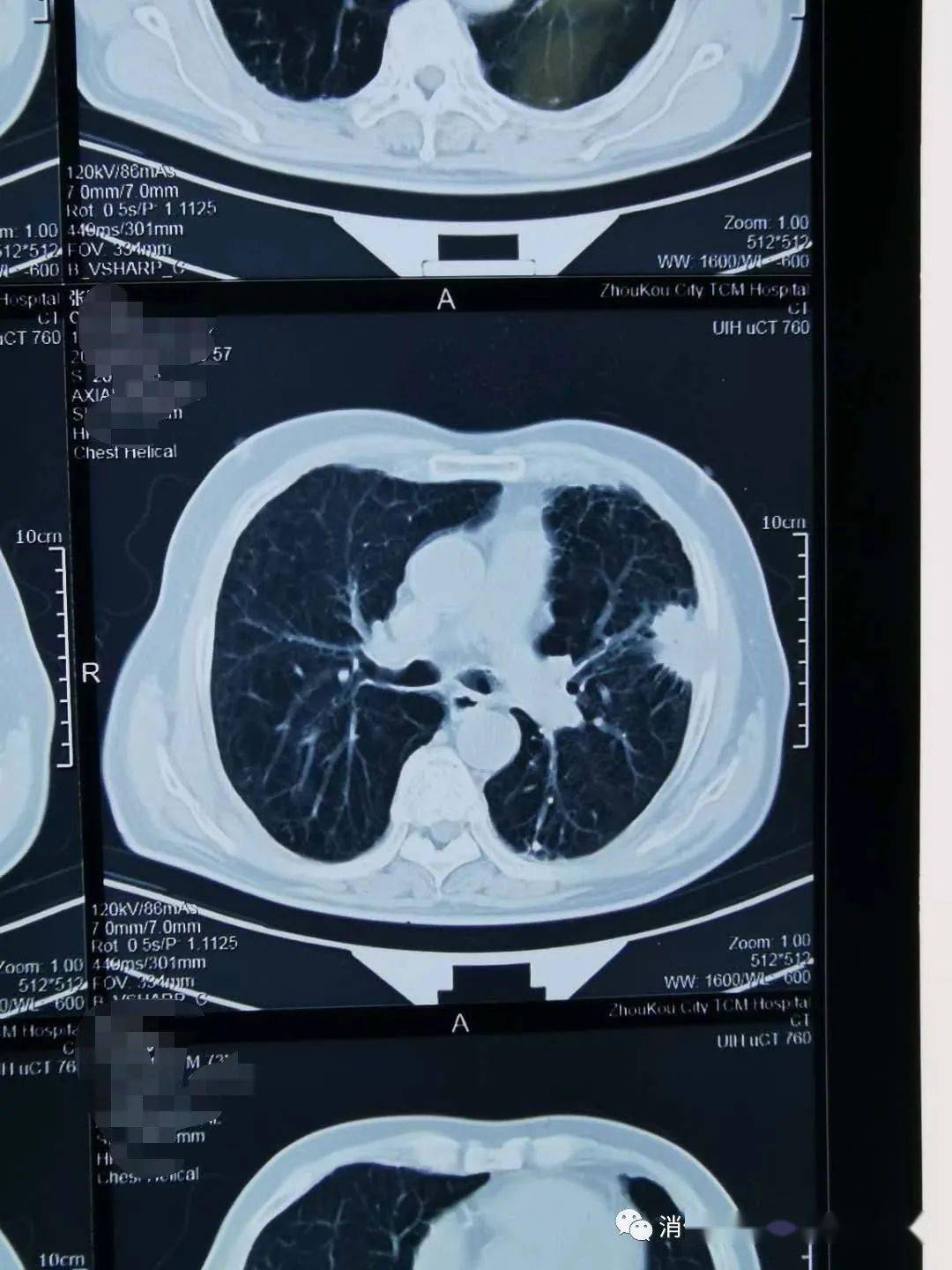 肺癌疑难病例究竟怎么治疗才好_恶性肿瘤