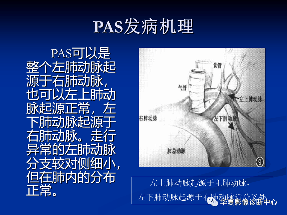 影像精读肺动脉吊带的影像学表现