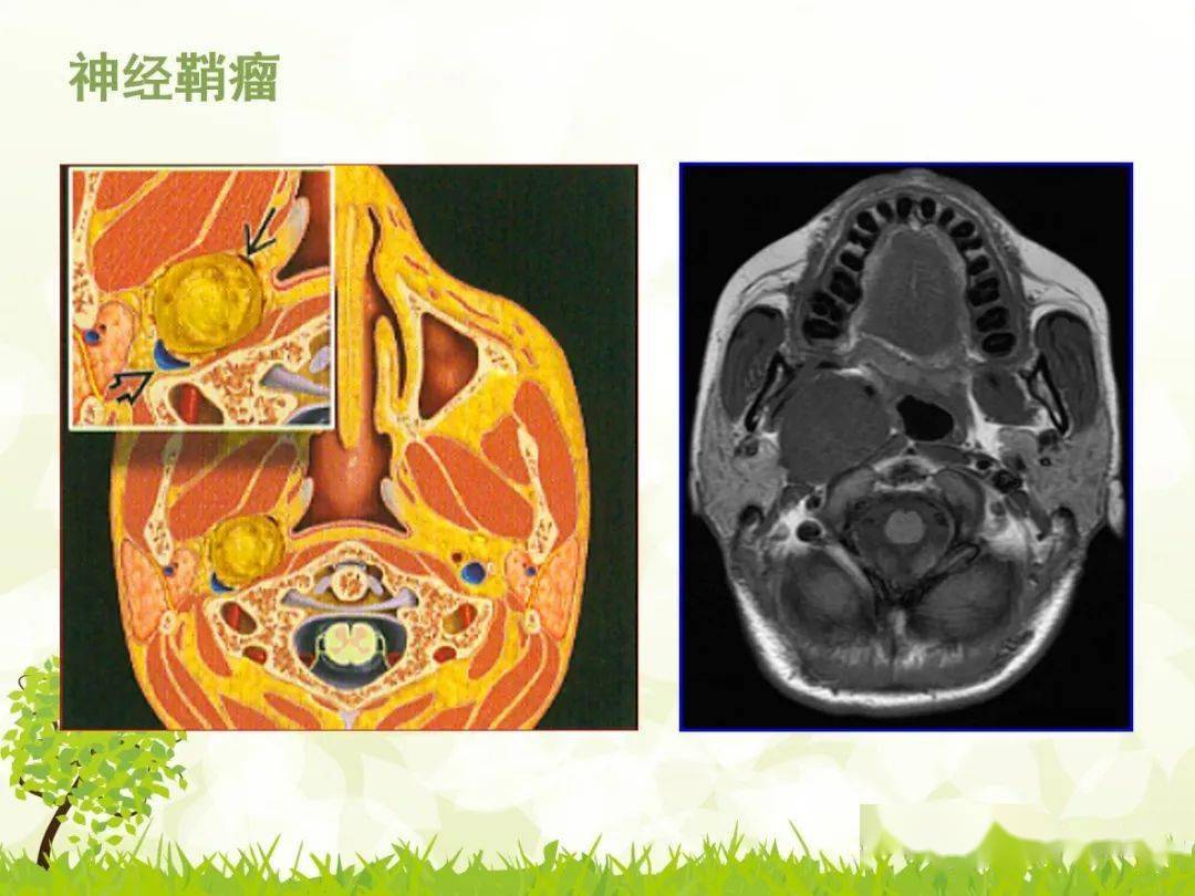 咽旁間隙解剖及常見病變影像表現